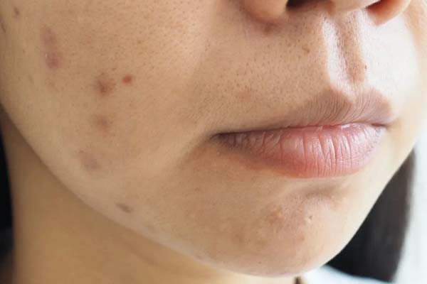 روش از بین بردن لک قهوه ای جای جوش