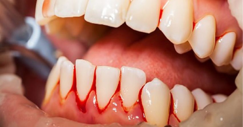 اگر مسواک نزنیم چه اتفاقی می‌افتد؟ ۷ عارضه دردناک که نمی‌دانید.