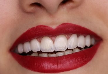 لمینت دندان در کرج | تجربه‌ای مطمئن برای لبخندی طبیعی و درخشان