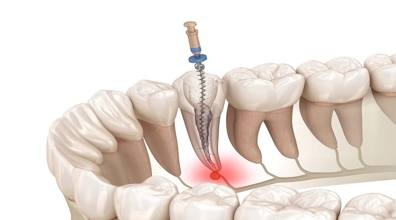 🔬 اندو (Endodontics) یا عصب‌کشی: نجات دندان از مرگ