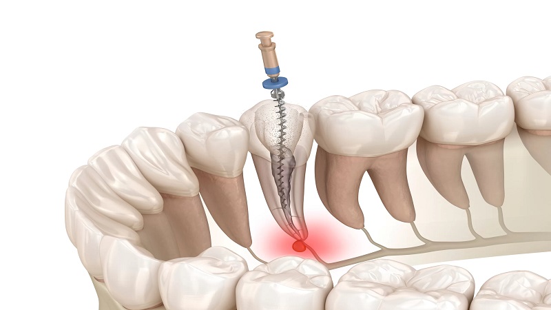 🔬 اندو (Endodontics) یا عصب‌کشی: نجات دندان از مرگ